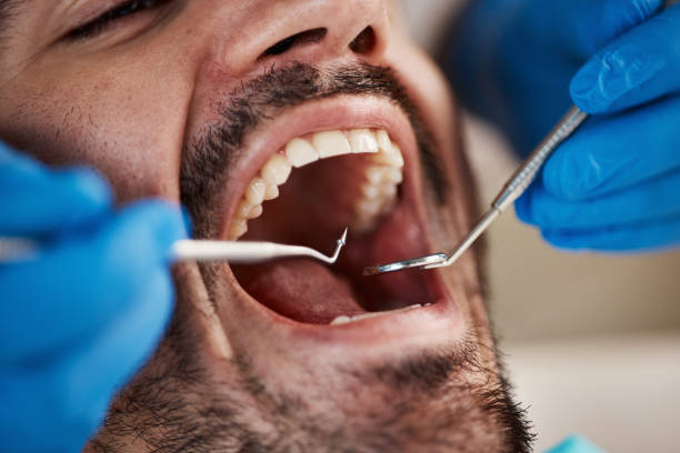 Best Emergency Wisdom Teeth Removal in Waterman, IL